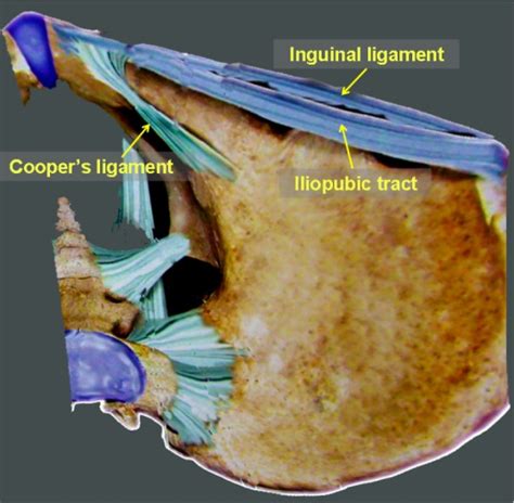 Anatomy essentials for laparoscopic inguinal hernia repair. - Abstract ...