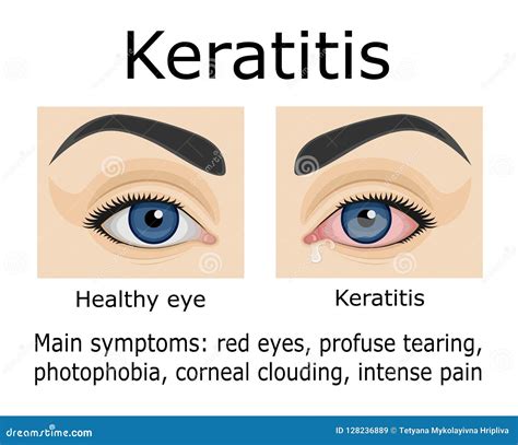 Keratitis Cartoons, Illustrations & Vector Stock Images - 129 Pictures ...