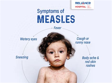 Symptoms of Measles