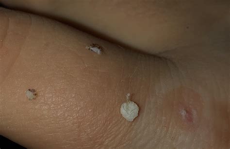 My wart finally fell off today! Look at those lil hairs in there. (On ...