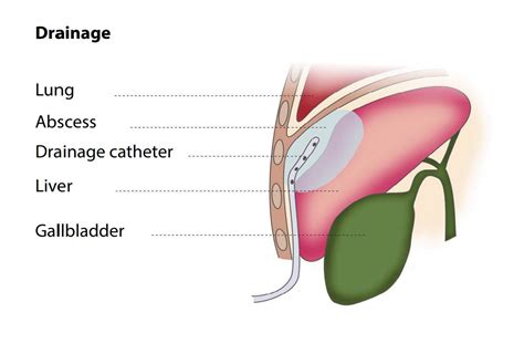 Percutaneous Abscess Drainage - FV Hospital