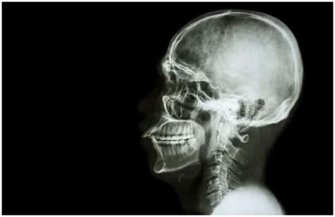 Dent In Skull (Top of the Head | Forehead | Back of the Head) - Causes ...