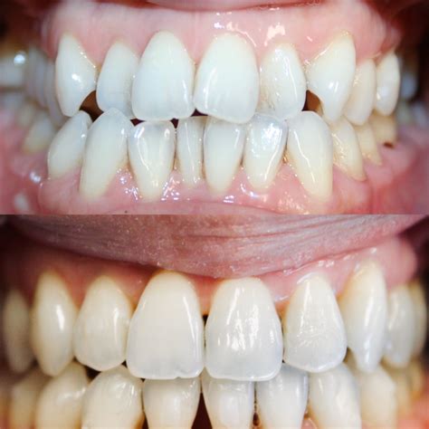 Invisalign Before And After | Firouz Orthodontics - West Los Angeles