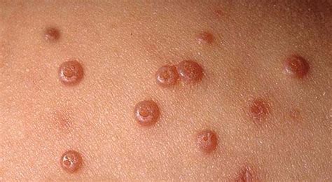 Molluscum Contagiosum - Dermatology - Medbullets Step 2/3