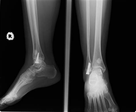 Fracture of Right Distal Fibula (Old screw site) – UNI CLINIC