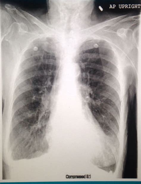 This is a Patient with lung hyperinflation from COPD. Increased work of ...