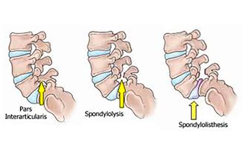 What is Spondylolysis? - Premia Spine