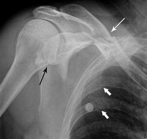 Comminuted Scapular Fracture