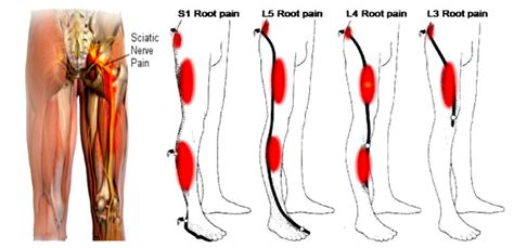 4 Types Of Sciatica Pain