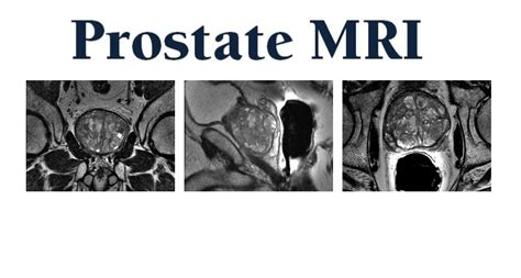 Prostate MRI