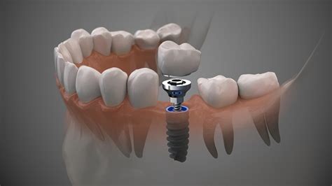 How an Implant Crown Is Attached - The Dental Place of Tamarac Tamarac ...