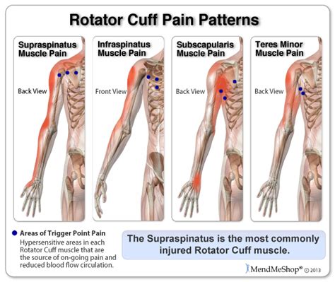 Rotator Cuff Treatments