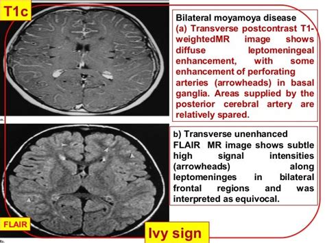 Moyamoya disease