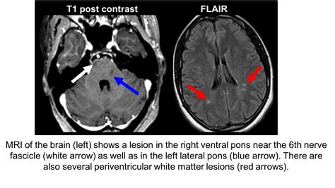 6th Nerve Palsy MRI