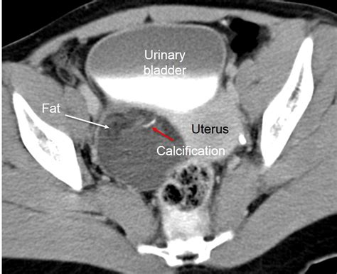 Cystic Teratoma Ovary