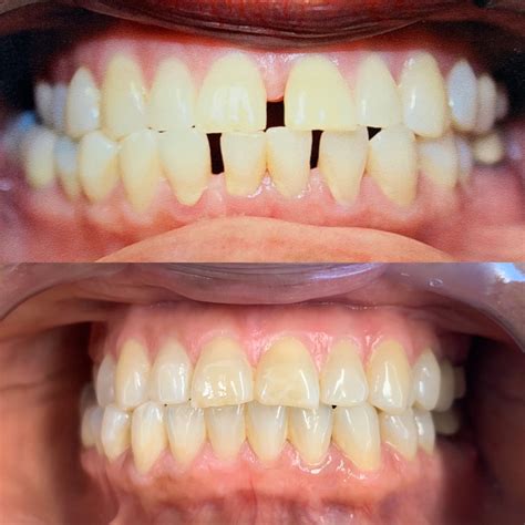 Invisalign Before And After | Firouz Orthodontics - West Los Angeles