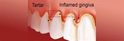 Caring for Red and Swollen Gums | Periodontal Disease Treatment Houston TX