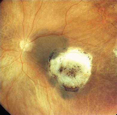 Laser Treatment of Choroidal Melanoma | Clinical Gate