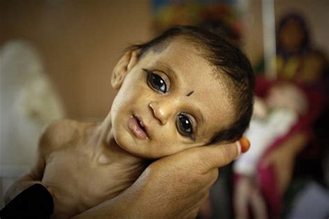 Malnutrition And Children : An Ugly Truth | Wrytin