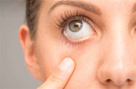 How Omega-3’s Can Help Treat Dry Eye | Stoney Creek Eye Care