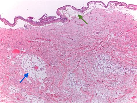 American Journal of Case Reports | Nevus Lipomatosus Superficialis in a ...