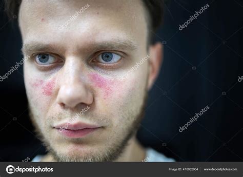 Age Spots Redness Face Young Man Sick Systemic Lupus Erythematosus ...