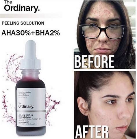 The Ordinary AHA 30% BHA 2% Peeling Solution | Facial skin care routine ...