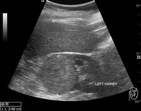 Kidney Tumor Ultrasound