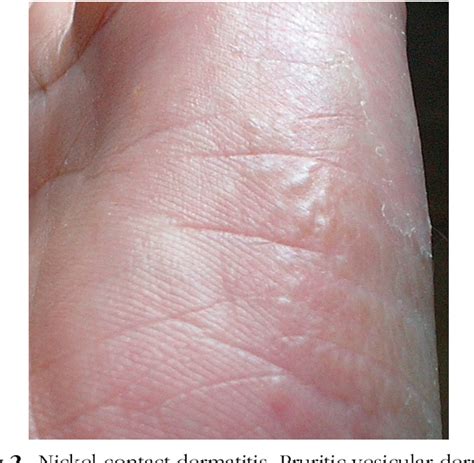 Figure 2 from Giant nevus lipomatosus cutaneous superficialis with ...