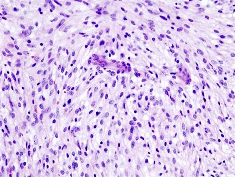 Uterine Leiomyosarcoma