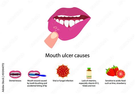 Aphthous Ulcer Causes