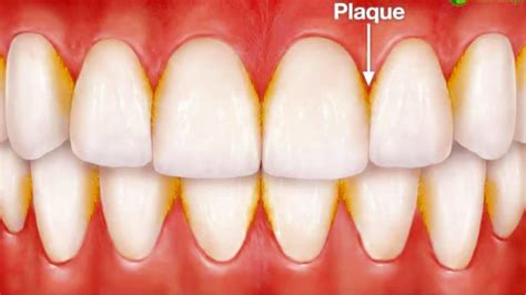 How To Get Rid Of Plaque Stains » Featurerecommendation