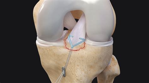 Tibial Spine Avulsion Fracture Reduction Using ACL Repair TightRope ...