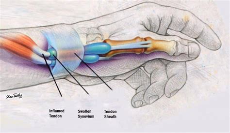 De Quervain tenosynovitis - almostadoctor