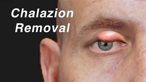 Chalazion Removal