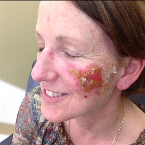 Actinic Keratosis Charlotte, NC | Actinic Keratosis Matthews, NC