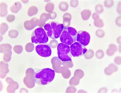 Scientists develop a marker for therapy response in acute myeloid leukemia