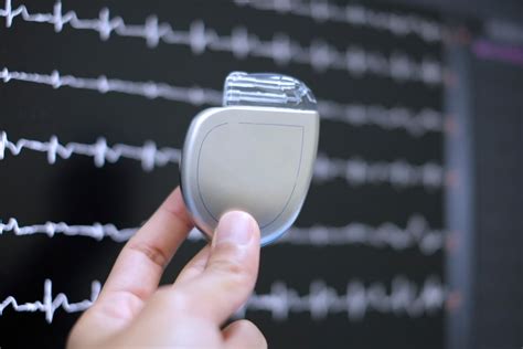 What You Need to Know About the Implantable Cardioverter Defibrillator ...