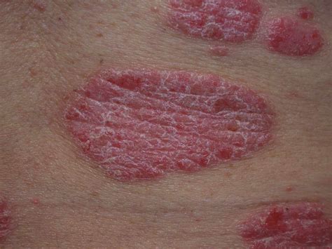 Plaque Psoriasis: Photos and Symptoms From Head to Toe