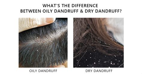 OILY Dandruff vs. DRY Dandruff: Causes, Differences, Symptoms Photos ...