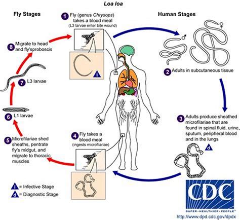 Loiasis - Infectious Diseases - MSD Manual Professional Edition