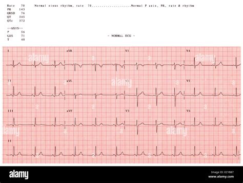 Normal Ecg Tracing