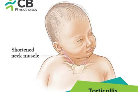 What is Torticollis? Symptoms, Causes, Diagnosis & Physiotherapy ...