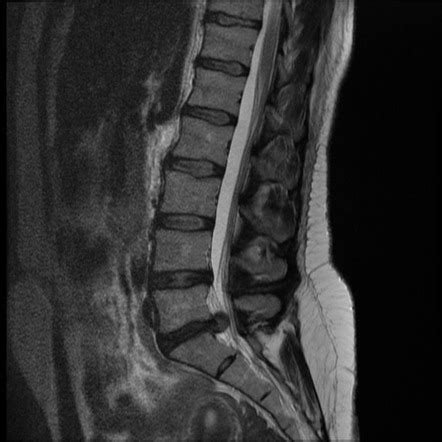 Disc extrusion - L5/S1 | Image | Radiopaedia.org