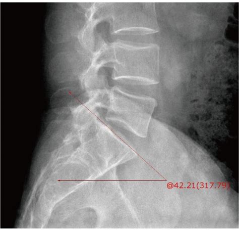 The promontory angle: the angles between sacral upper margin and ...