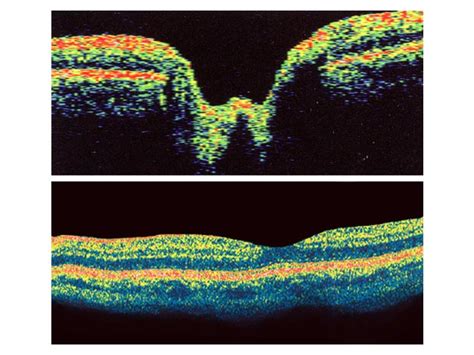 Optical Coherence Tomography OCT – Retina & Optic Nerve Scan - South ...