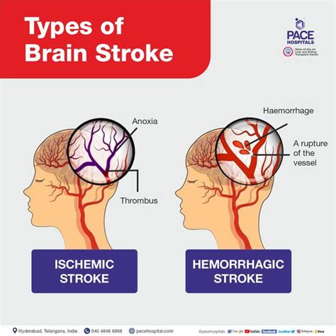 Stroke Causes