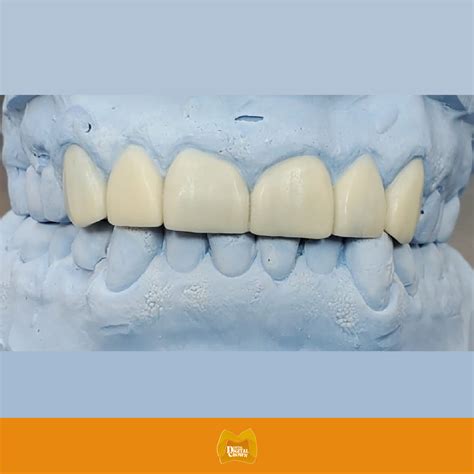 DIAGNOSTIC WAXUP PER UNIT – Dental Digital Crown