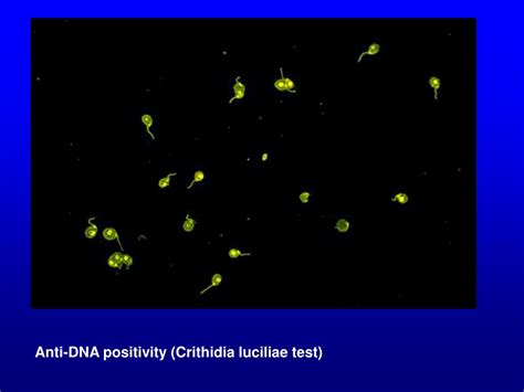 PPT - SYSTEMIC LUPUS ERYTHEMATOSUS (SLE) PowerPoint Presentation, free ...