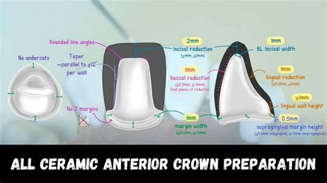 ALL CERAMIC ANTERIOR CROWN PREPARATION Step by Step - Dr. Peter Grieco